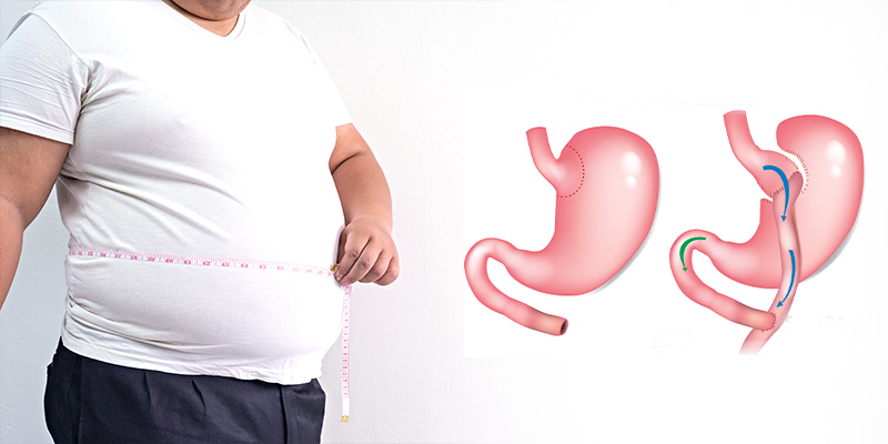 gastrik_bypass_ameliyati